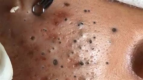 dr pimple blackheads|50 minutes of blackheads.